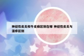 神经性皮炎和牛皮癣区别在哪 神经性皮炎与湿疹区别