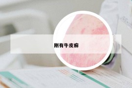 刚有牛皮癣