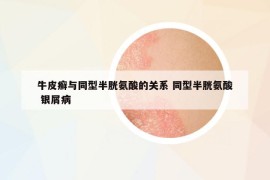 牛皮癣与同型半胱氨酸的关系 同型半胱氨酸 银屑病