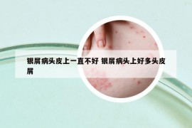 银屑病头皮上一直不好 银屑病头上好多头皮屑