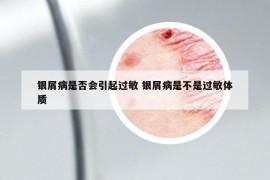 银屑病是否会引起过敏 银屑病是不是过敏体质