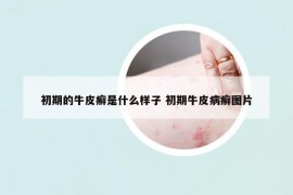 初期的牛皮癣是什么样子 初期牛皮病癣图片