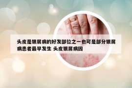 头皮是银屑病的好发部位之一也可是部分银屑病患者最早发生 头皮银屑病因