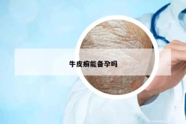 牛皮癣能备孕吗