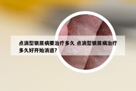 点滴型银屑病要治疗多久 点滴型银屑病治疗多久好开始消退?