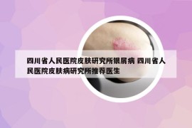 四川省人民医院皮肤研究所银屑病 四川省人民医院皮肤病研究所推荐医生