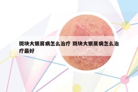 斑块大银屑病怎么治疗 斑块大银屑病怎么治疗最好