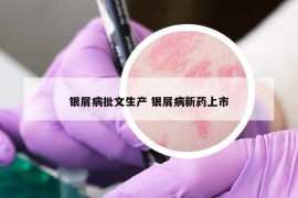银屑病批文生产 银屑病新药上市