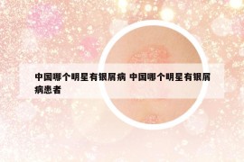 中国哪个明星有银屑病 中国哪个明星有银屑病患者