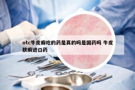 otc牛皮癣吃的药是真的吗是国药吗 牛皮肤癣进口药