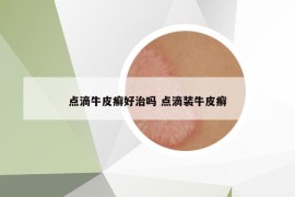 点滴牛皮癣好治吗 点滴装牛皮癣