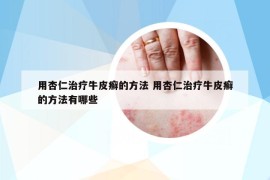 用杏仁治疗牛皮癣的方法 用杏仁治疗牛皮癣的方法有哪些