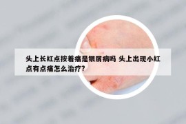 头上长红点按着痛是银屑病吗 头上出现小红点有点痛怎么治疗?