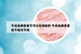 牛皮血癣患者不可以吃辣椒和 牛皮血癣患者能不能吃牛蛙