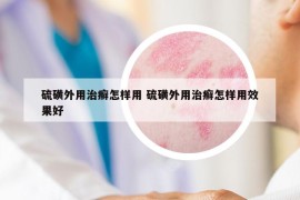 硫磺外用治癣怎样用 硫磺外用治癣怎样用效果好