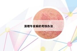 清理牛皮癣的考核办法