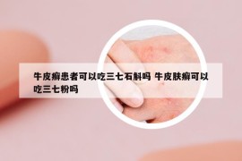 牛皮癣患者可以吃三七石斛吗 牛皮肤癣可以吃三七粉吗
