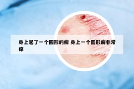 身上起了一个圆形的癣 身上一个圆形癣非常痒