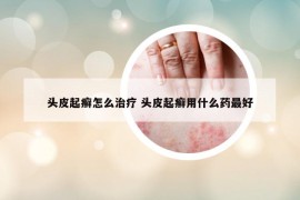 头皮起癣怎么治疗 头皮起癣用什么药最好