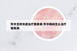 怀孕怎样快速治疗银屑病 怀孕期间怎么治疗银屑病