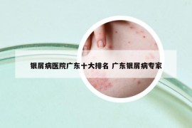 银屑病医院广东十大排名 广东银屑病专家