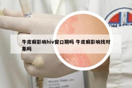 牛皮癣影响hiv窗口期吗 牛皮癣影响找对象吗