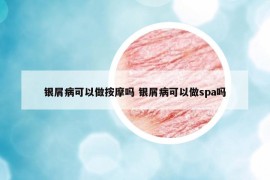 银屑病可以做按摩吗 银屑病可以做spa吗