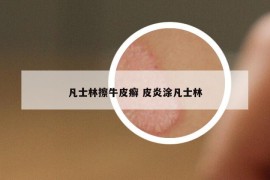凡士林擦牛皮癣 皮炎涂凡士林