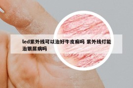 led紫外线可以治好牛皮癣吗 紫外线灯能治银屑病吗