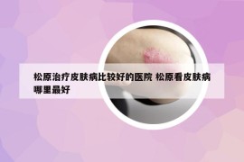 松原治疗皮肤病比较好的医院 松原看皮肤病哪里最好