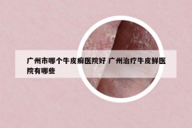 广州市哪个牛皮癣医院好 广州治疗牛皮鲜医院有哪些