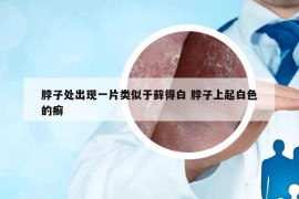 脖子处出现一片类似于藓得白 脖子上起白色的癣