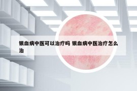 银血病中医可以治疗吗 银血病中医治疗怎么治