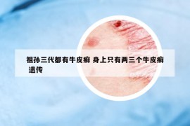 祖孙三代都有牛皮癣 身上只有两三个牛皮癣 遗传