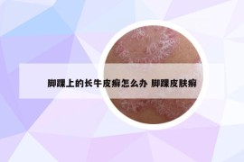 脚踝上的长牛皮癣怎么办 脚踝皮肤癣