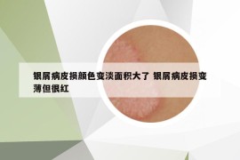 银屑病皮损颜色变淡面积大了 银屑病皮损变薄但很红