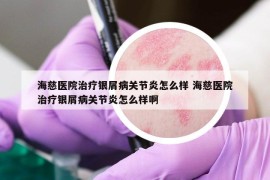 海慈医院治疗银屑病关节炎怎么样 海慈医院治疗银屑病关节炎怎么样啊