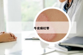 牛皮癣红枣