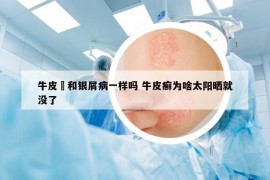 牛皮癬和银屑病一样吗 牛皮癣为啥太阳晒就没了
