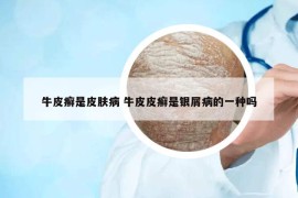 牛皮癣是皮肤病 牛皮皮癣是银屑病的一种吗