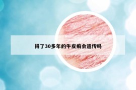 得了30多年的牛皮癣会遗传吗