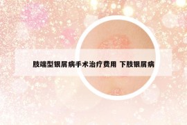 肢端型银屑病手术治疗费用 下肢银屑病