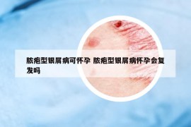 脓疱型银屑病可怀孕 脓疱型银屑病怀孕会复发吗