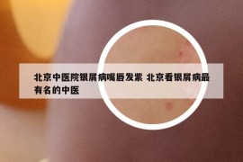 北京中医院银屑病嘴唇发紫 北京看银屑病最有名的中医