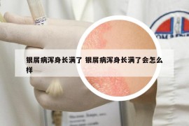 银屑病浑身长满了 银屑病浑身长满了会怎么样