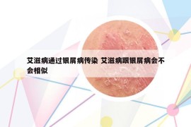 艾滋病通过银屑病传染 艾滋病跟银屑病会不会相似