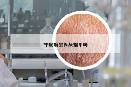 牛皮癣会长灰指甲吗