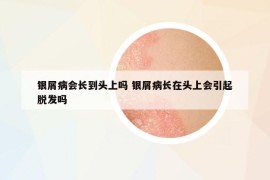 银屑病会长到头上吗 银屑病长在头上会引起脱发吗