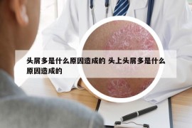 头屑多是什么原因造成的 头上头屑多是什么原因造成的