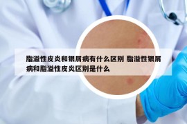 脂溢性皮炎和银屑病有什么区别 脂溢性银屑病和脂溢性皮炎区别是什么